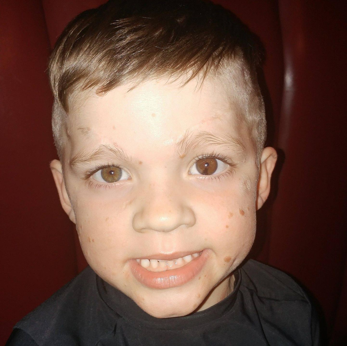 Dylan ma niewielkie blizny