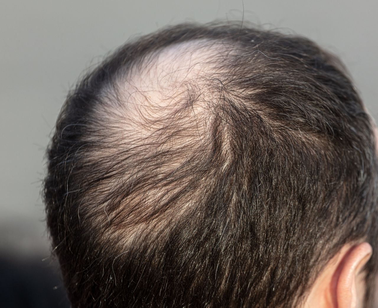 Łysienie androgenowe – przyczyny, objawy i leczenie