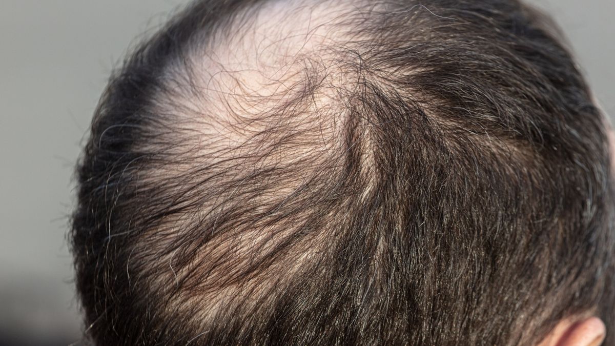 Łysienie androgenowe skutkuje osłabieniem i utratą włosów
