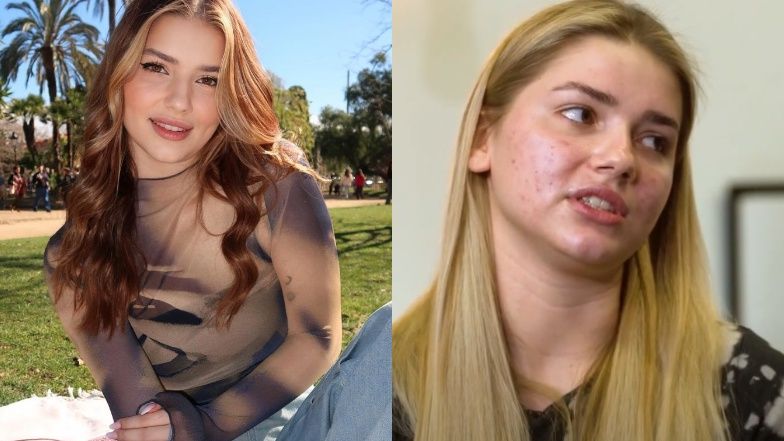 Julia Żugaj walczyła z trądzikiem