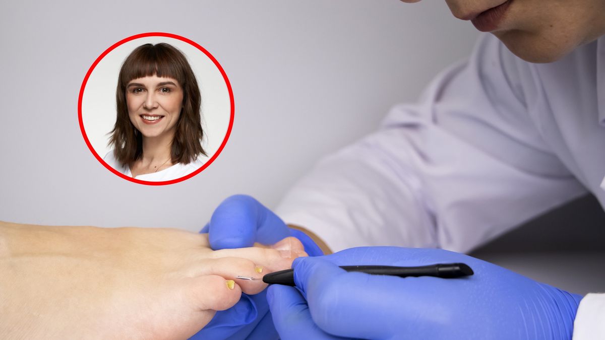 Grzybica paznokci to powszechny problem