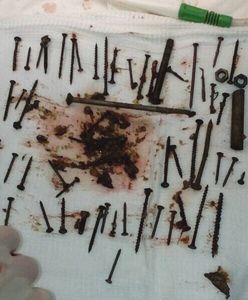 Przerażające odkrycie lekarzy. Wyjęli 150 metalowych elementów z brzucha więźniarki