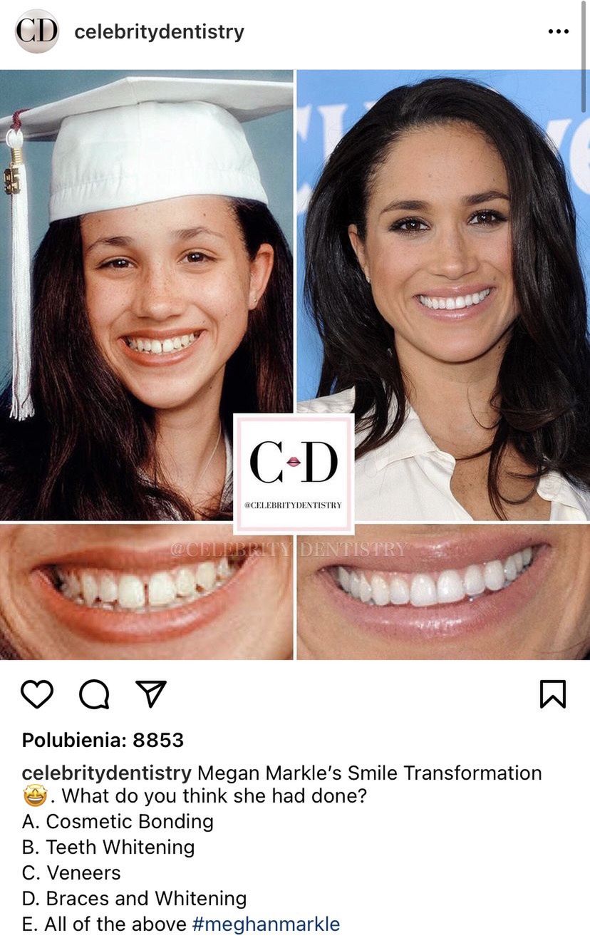 Meghan Markle poprawiła uzębienie
