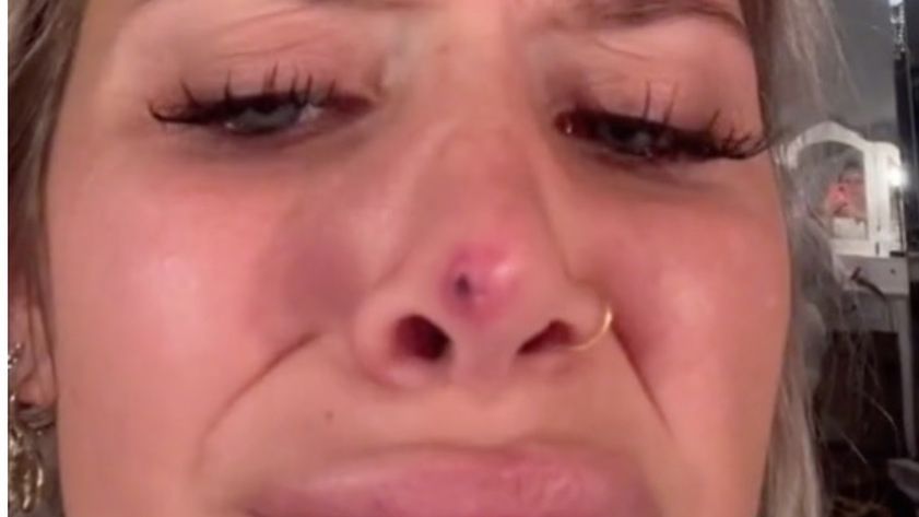 Kobieta pokazała jakie mogą być powikłania po wykonaniu korekty nosa