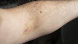 Dowiedz się, jak rozpoznać czerniaka