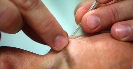 Medycyna alternatywna: akupunktura