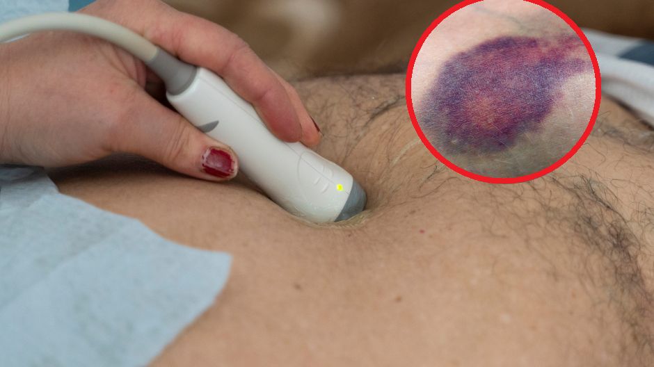 Pojawia się przy ostrym zapaleniu trzustki. Pod żadnym pozorem nie ignoruj znaku Cullena