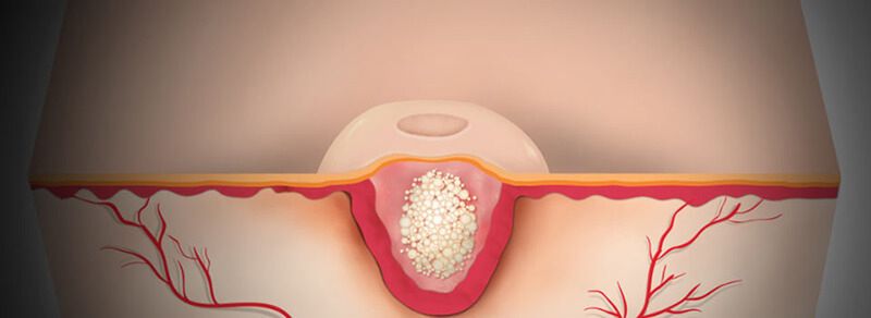 Mięczak zakaźny jest wirusową chorobą skóry