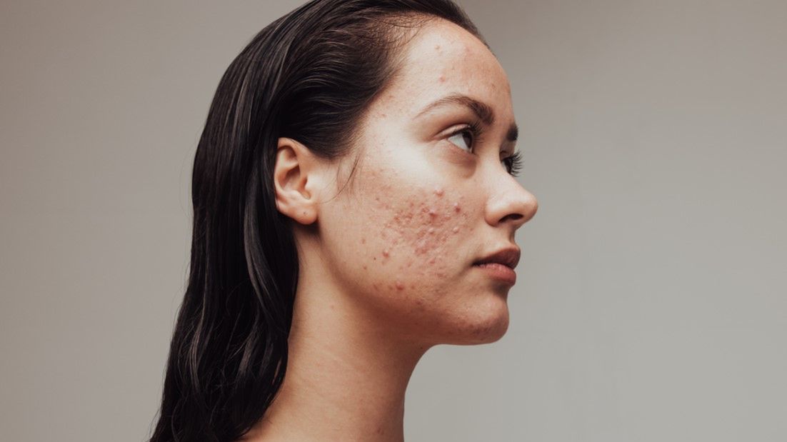 Wskazaniem do stosowania nadtlenku benzoilu jest trądzik pospolity.