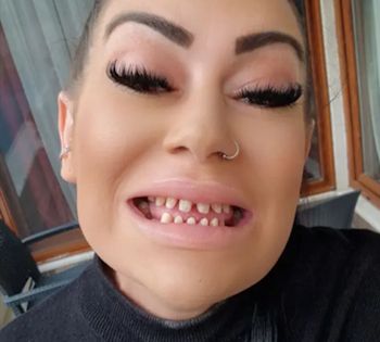 Brytyjka zrobiła "tureckie zęby". Nie do wiary, ile na nie wydała