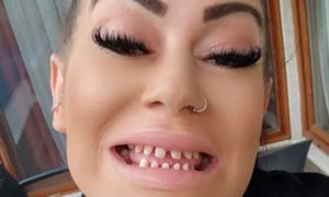 Brytyjka zrobiła "tureckie zęby". Nie do wiary, ile na nie wydała