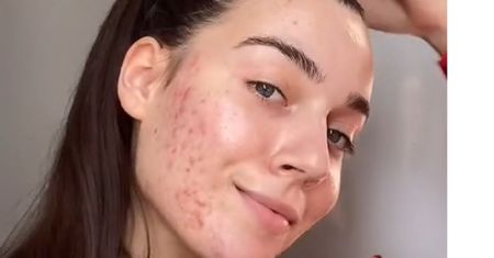 Tiktokerka nie wstydzi się pokazywać twarzy z trądzikiem. Promuje "acne positivity"
