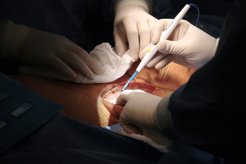Rak jelita grubego i odbytnicy - operacja chirurgiczna 