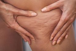 Uciążliwy cellulit. Rozpocznij walkę ze skórką pomarańczową już dziś