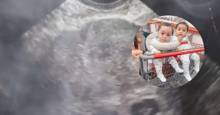 Jedno z bliźniąt urodziło się z zespołem Downa. Matka nie chciała usunąć płodu