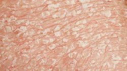 Leczenie łuszczycy - jak przebiega kuracja, profilaktyka