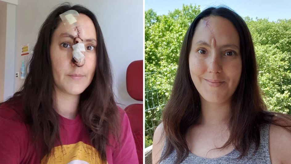 Pryszcz na nosie okazał się nowotworem skóry