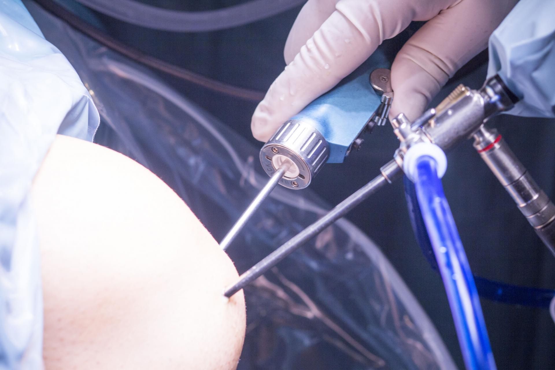 Artroskop jest odmianą endoskopu (123rf)