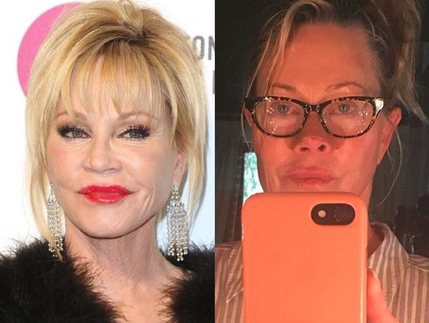 Melanie Griffith walczy z nowotworem skóry: "To ostatni krok, aby wyleczyć raka"