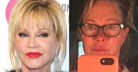 Melanie Griffith walczy z nowotworem skóry: "To ostatni krok, aby wyleczyć raka"