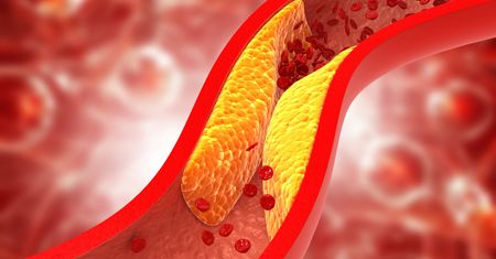 Miażdżyca kończyn dolnych – przyczyny, objawy, diagnostyka, leczenie, powikłania