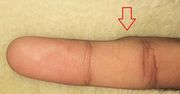 Zwróć uwagę na swój palec. Ten objaw to ostrzeżenie