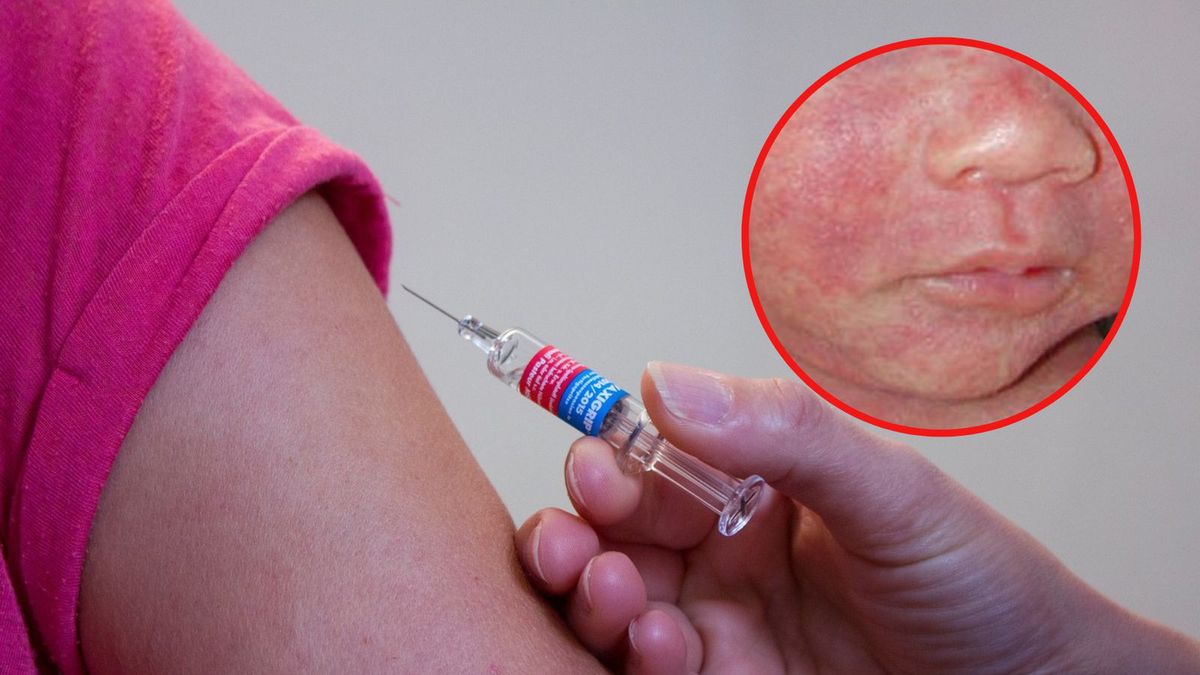 Odrą zarazić się może każdy, ale najbardziej narażone są dzieci