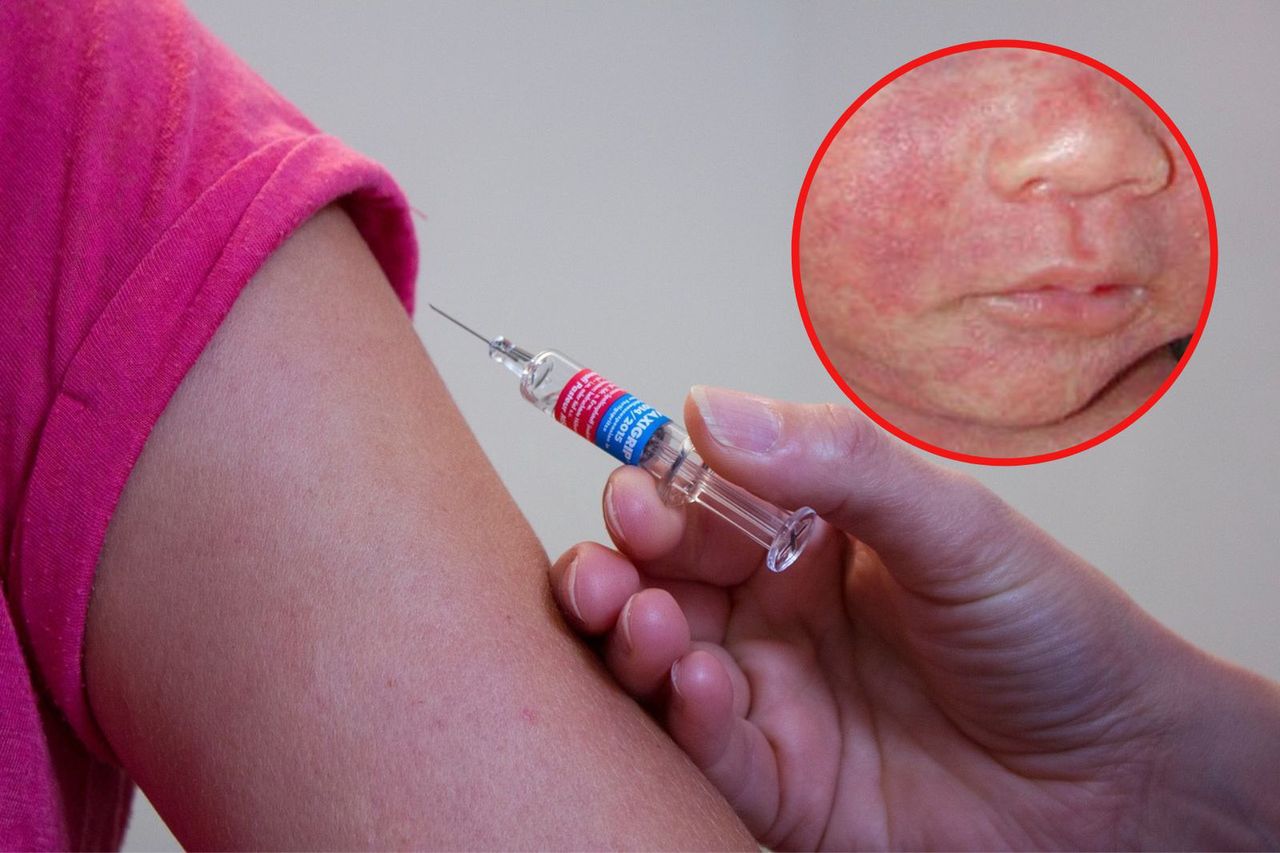 Over half of global population at risk by 2024: Measles threatens in vaccination gaps, WHO warns