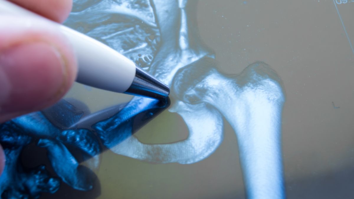 Alloplastyka pozwala przywrócić prawidłową ruchomość i stabilność stawu