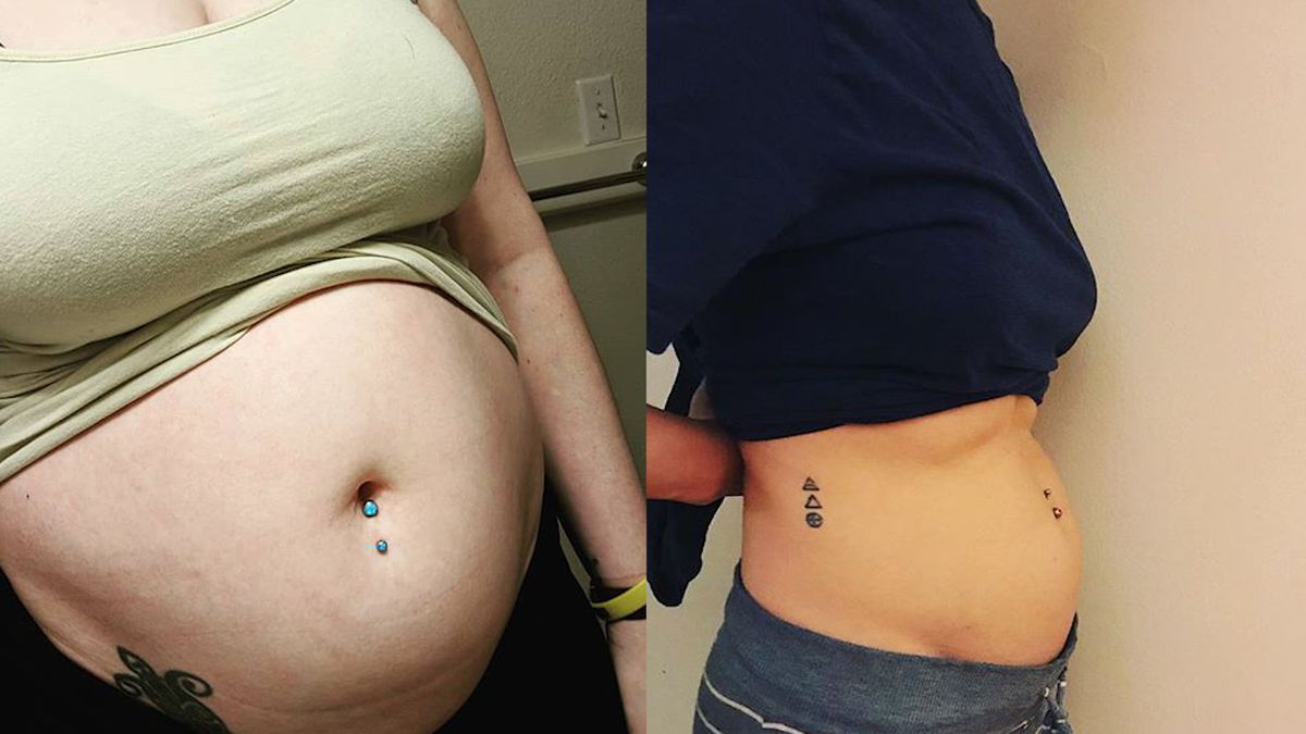 Mało znany objaw endometriozy