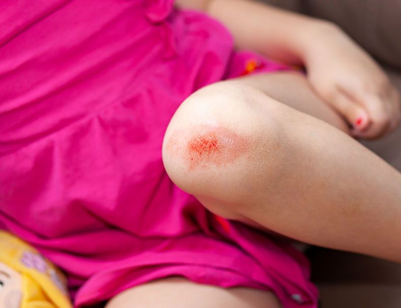 Otarcia – wygląd, przyczyny i pierwsza pomoc