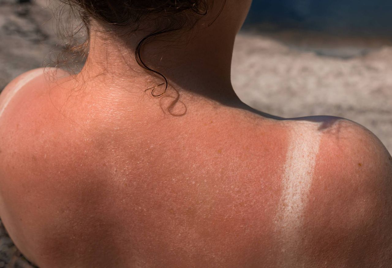 Avoid these foods to prevent sun sensitivity while tanning