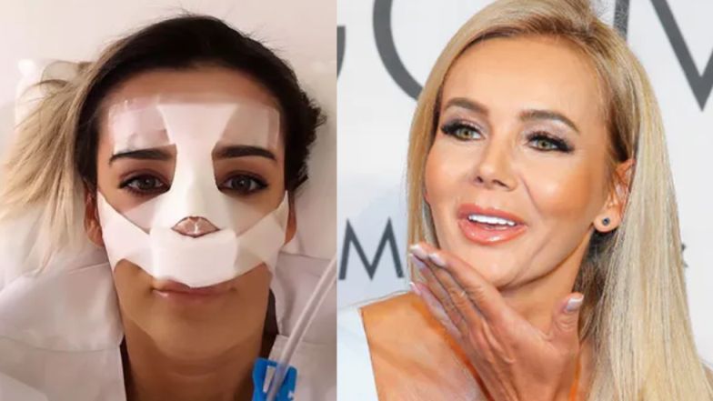 Monika Chwajoł z "Królowych życia" pokazała zdjęcia sprzed operacji nosa