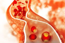 Zatorowość cholesterolowa  - przyczyny, objawy, leczenie i profilaktyka