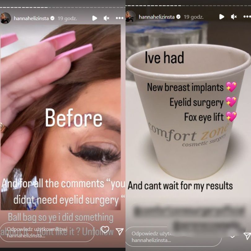 Uczestniczka brytyjskiego "Love Island" chwali się efektami operacji w tureckiej klinice