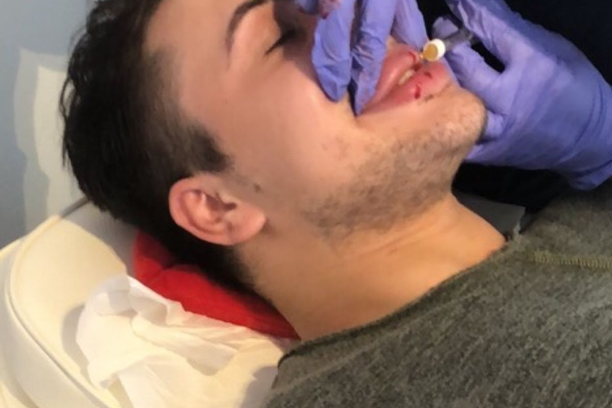 Mężczyzna co dwa miesiące powiększa sobie usta. Wygląda coraz gorzej