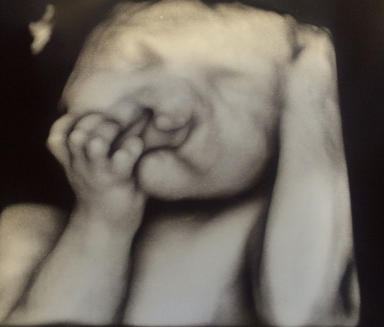 Odmówili aborcji synka z powodu deformacji. Tak chłopiec wygląda dzisiaj