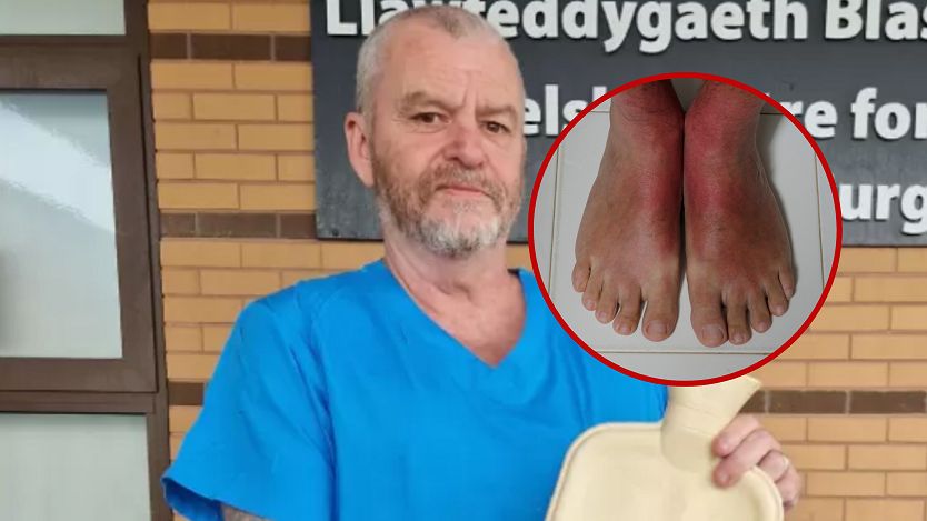 Termofor wypełniony wrzącą wodą może być niebezpieczny