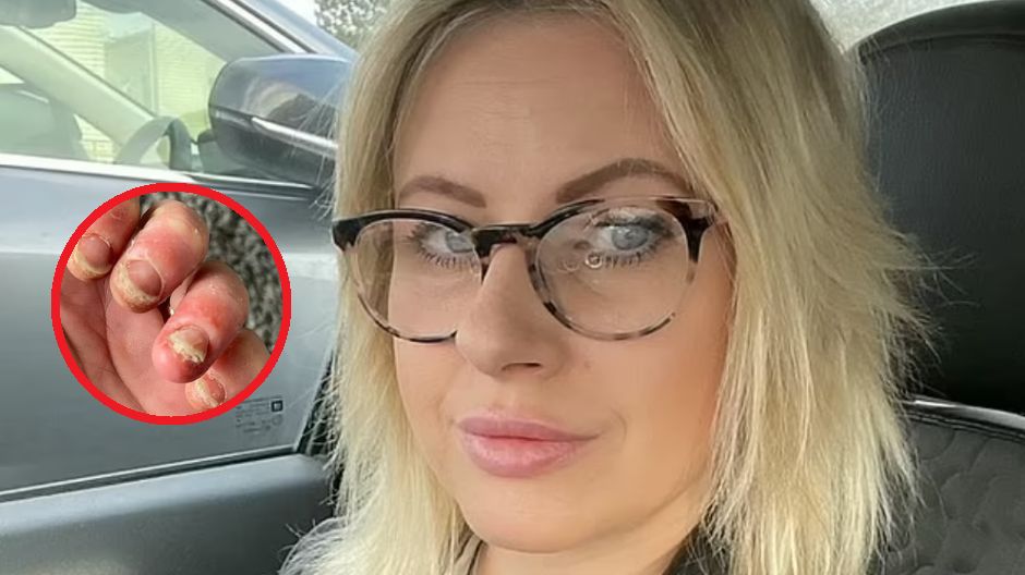 Codzienne czynności sprawiają jej ból. Winna alergia na składniki lakierów do paznokci