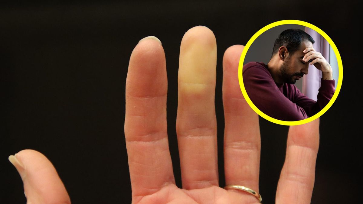 Zespół Raynauda może zwiastować tocznia