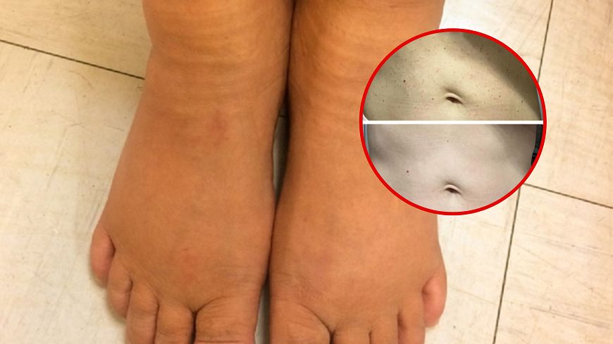 "Rubinki" na skórze mogą wskazywać na poważne problemy - z wątrobą, hormonami i układem krążenia