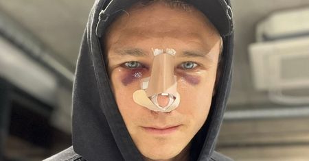 Jakub Rzeźniczak pozuje po operacji nosa i odpowiada na komentarz "życzliwej" internautki: "Miałam nadzieję, że KTOŚ CI WALNĄŁ" (FOTO)