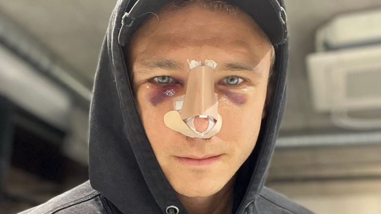 Jakub Rzeźniczak chwali się nosem w opatrunkach