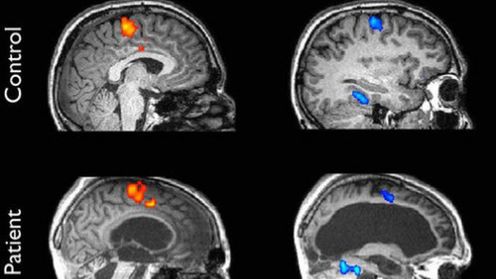 Skan mózgu wyjawił, że pacjent w stanie wegetatywnym potrafi udzielać prostych odpowiedzi 1