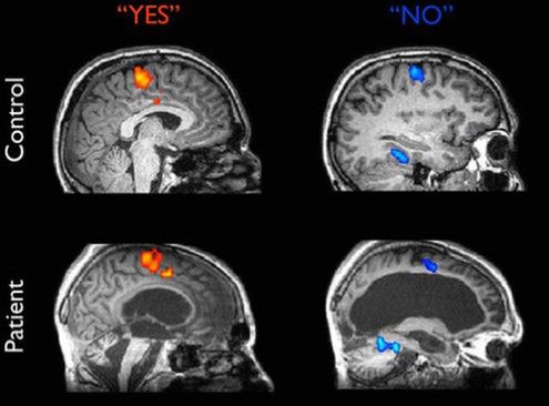 Skan mózgu wyjawił, że pacjent w stanie wegetatywnym potrafi udzielać prostych odpowiedzi