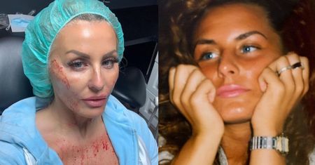 Dagmara Kaźmierska OSTRZYKNĘŁA SOBIE TWARZ! "Naturalne piękno zawsze się obroni" (FOTO)
