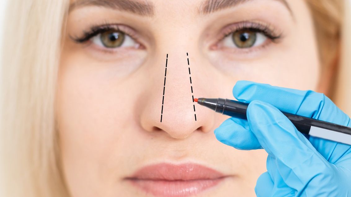 Krzywa przegroda nosa niejednokrotnie jest przyczyną poważnych dolegliwości zdrowotnych. Z tego powodu wiele osób decyduje się na operację plastyki nosa.