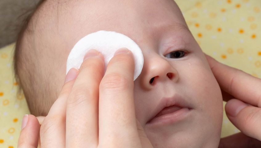 Udrożnienie kanału łzowego u niemowląt polega na wykonaniu zespolenia pomiędzy workiem łzowym a jamą nosową