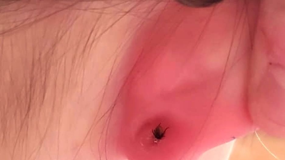 Kleszcze uwielbiają to miejsce. Lekarka pokazała zdjęcie dziecka