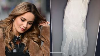 Ewelina Lisowska PRZEJECHAŁA sobie po stopie motocyklem. Pokazała nawet zdjęcie rentgenowskie. "Palce nie wyglądały za dobrze"